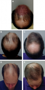 donor area hair transplant
