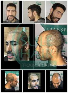 sule hair transplant before and after pictures