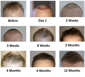 hair transplant growth timelines