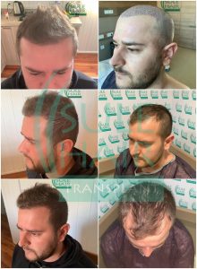 sule hair transplant before and after pictures