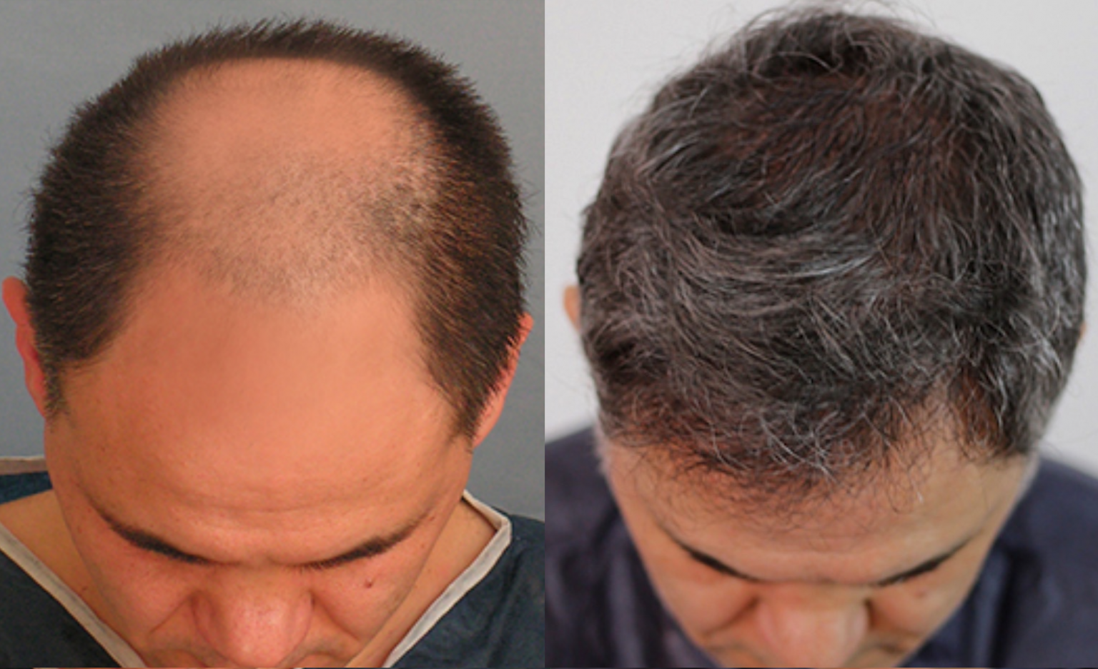 Are Hair Transplants Worth it? My Hair Implants