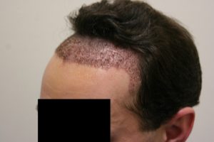 hair transplant recovery