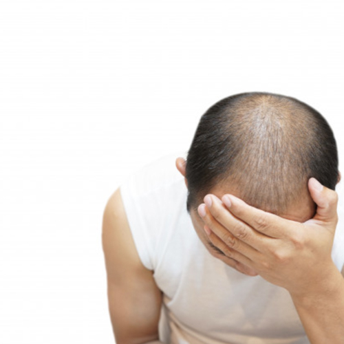 are hair transplants worth it?