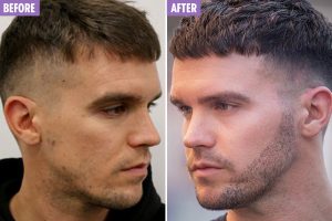 before and after beard transplant