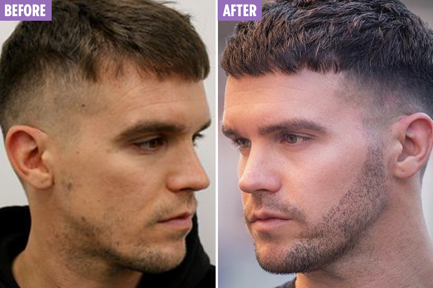 Read this before having a beard transplant [in 2021] My Hair Implants
